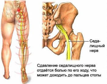 боли в пояснице