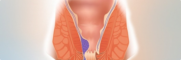 Геморрой – болезнь современных людей