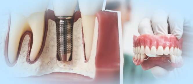 Протезирования И Имплантация Зубов