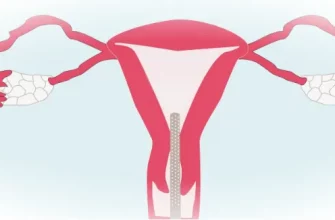 Симптомы эндометриоза матки, причины и основы лечения