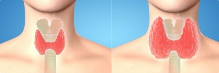 Увеличение щитовидной железы, причины, симптомы увеличения щитовидной железы