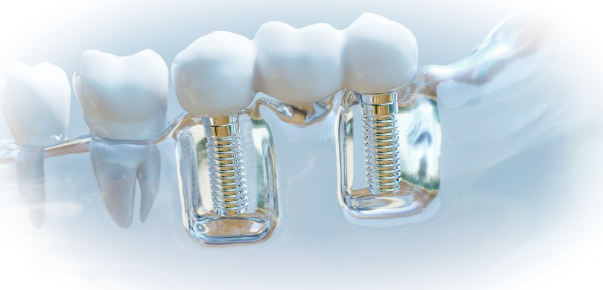 Приживляемость зубных имплантов