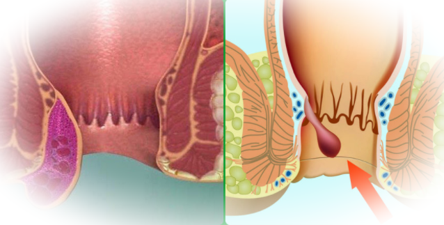 Почему возникает геморрой и этапы его развития