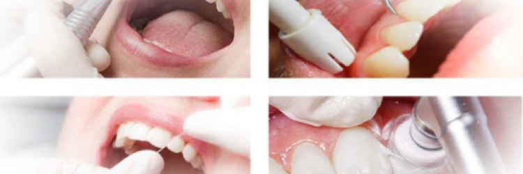 Профессиональная чистка зубов: показания, польза, особенности проведения