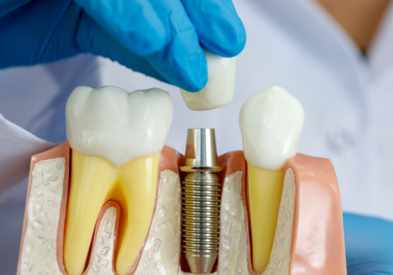 Имплантация зубов: виды и преимущества