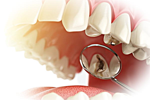 Кариес: этапы развития и лечение