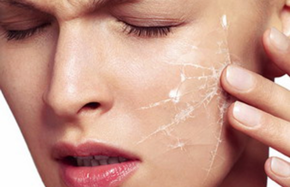 Шелушение кожи лица: причины, способы устранения, диета