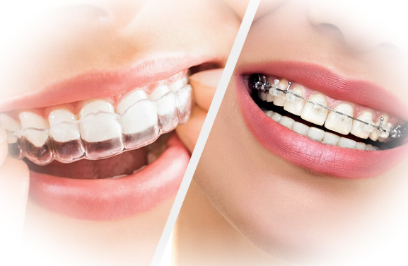 Выравнивание зубов: виды брекет-систем и тактика лечения