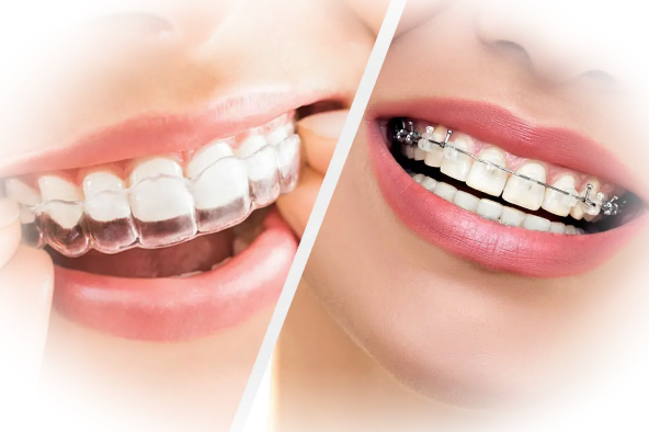 Вопросы к ортодонту: Чем опасны зубные брекеты?