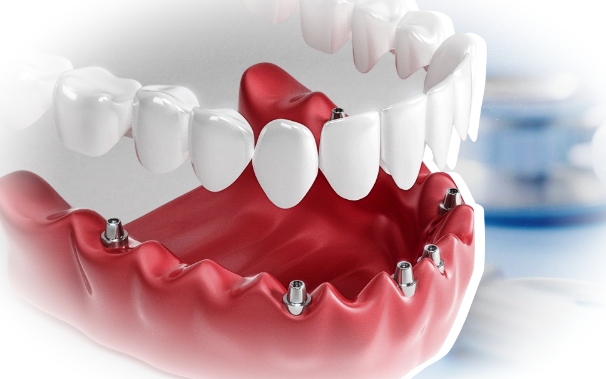Имплантация зубов «All on 4»