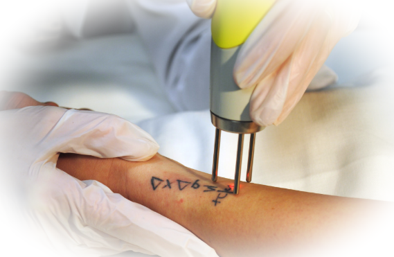 Лазерное удаление тату – новшества медицины