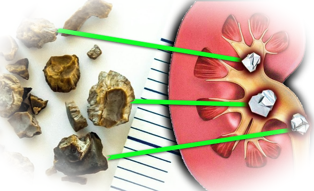 Оксалатные камни (оксалаты) в почках