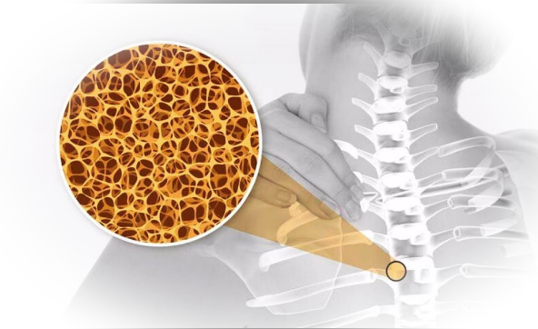 Что такое остеопороз и как его определить