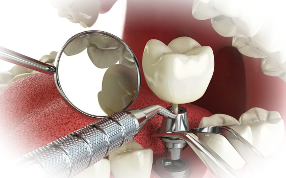 Особенности имплантации зубов и немного об удалении зуба мудрости