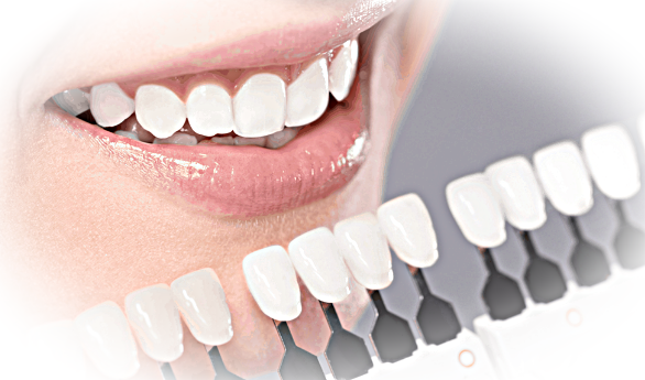 Отбеливание зубов - как проводится и когда рекомендуется