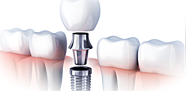 Что такое имплантация зубов и как она проходит: основные этапы и рекомендации по уходу за имплантатами