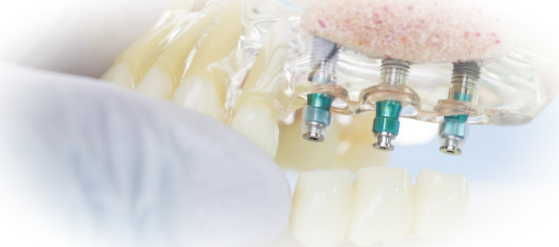 Положительные стороны зубных имплантатов