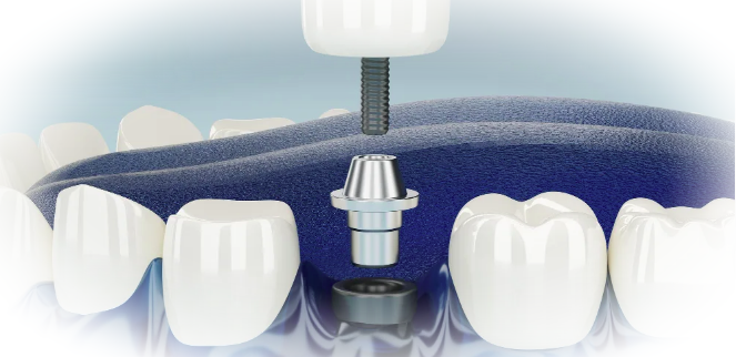 Имплантация зубов: Революция в стоматологии для крепкой улыбки и здоровья