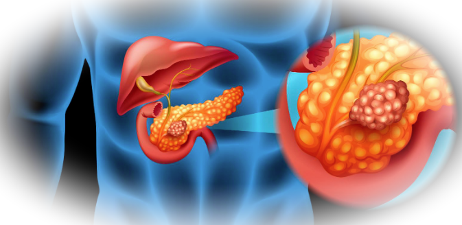 Современные подходы к лечению рака поджелудочной железы