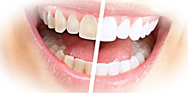 Эффекты отбеливания