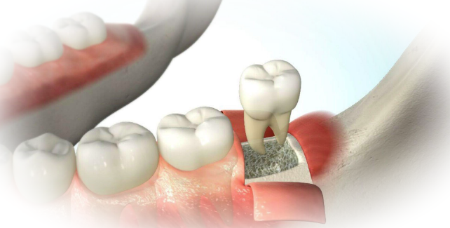 Как проходит процедура удаления дистопированного зуба?