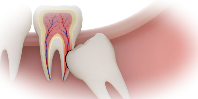 Удаление дистопированного зуба: причины, показания к удалению