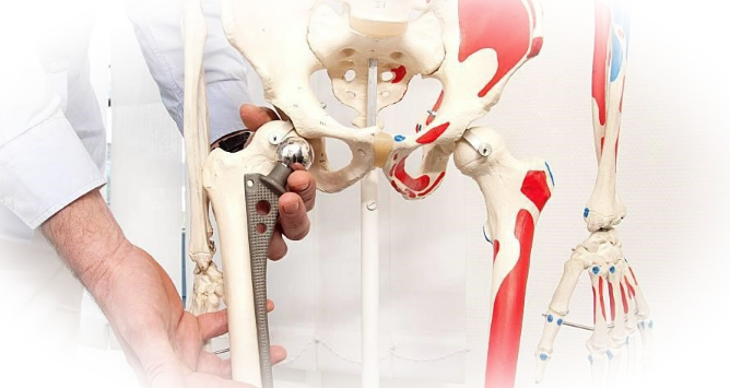 Эндопротезирование тазобедренного сустава: от показаний до реабилитации
