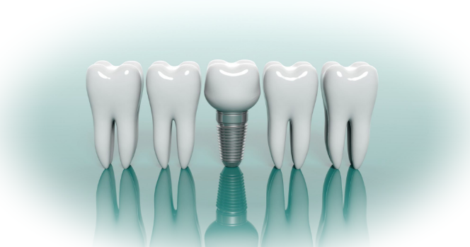 Как проходит установка зубного имплантата?