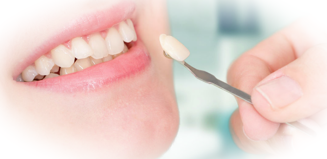Как проходит процедура зубного бондинга