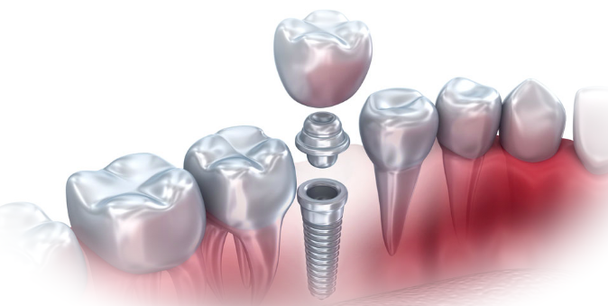 варианты имплантации зубов