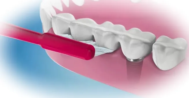 Чистка зубных имплантов