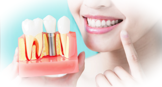 Как зубные имплантаты могут улучшить вашу улыбку и жизнь?