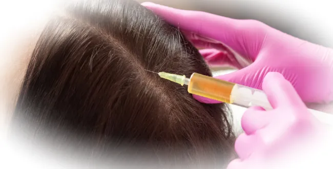 PRP - терапия на волосы