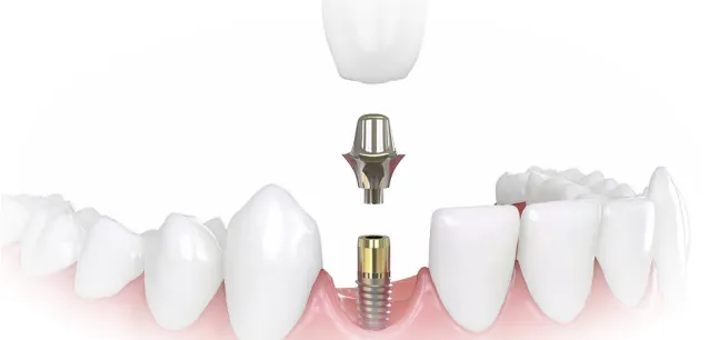 Имплантация зуба