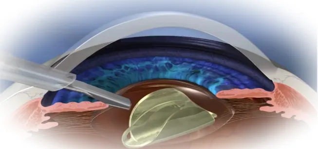 Ход операции удаления катаракты