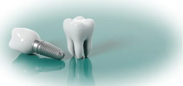 Имплантация зубов под ключ: быстрый путь к идеальной улыбке