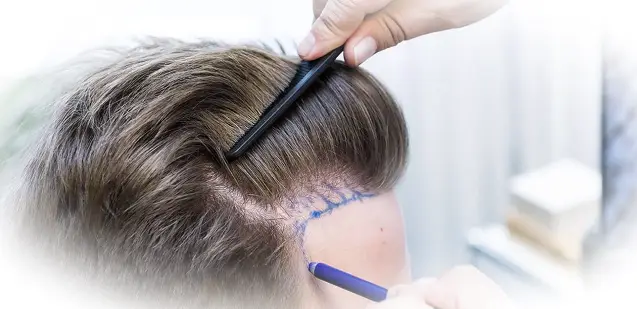 Пересадка волос. Как имплантируют волосы?