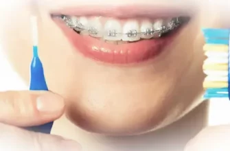 Брекеты: как правильно за ними ухаживать и как чистить зубы?