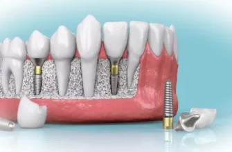 Показания и противопоказания к двухэтапной имплантации зубов