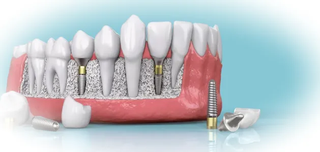 Показания и противопоказания к двухэтапной имплантации зубов