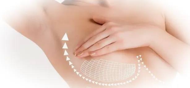 Результаты мастопексии