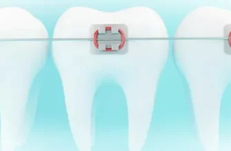 Идеальный возраст для установки брекетов. Преимущества и рекомендации