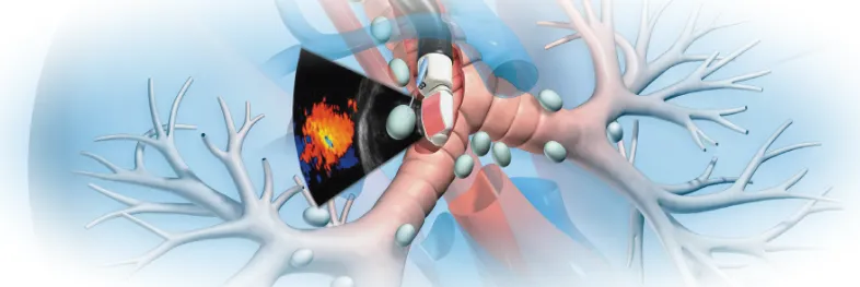 Бронхоскопия