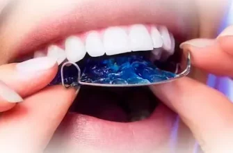 Детские пластины: эффективный и комфортный способ исправления прикуса