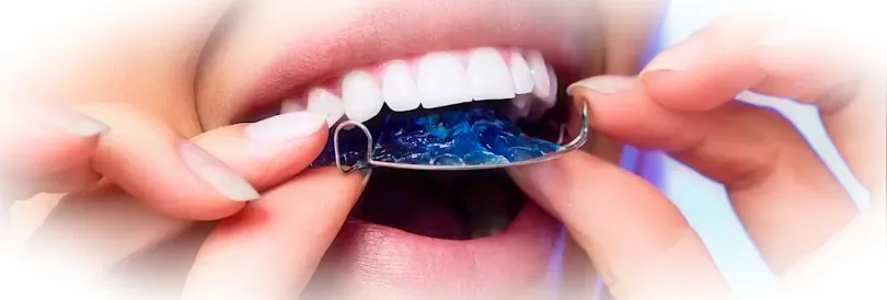 Детские пластины: эффективный и комфортный способ исправления прикуса