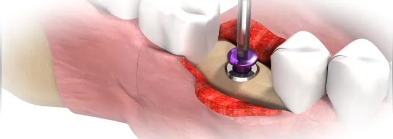 Этапы имплантации