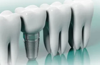 Импланты в стоматологии