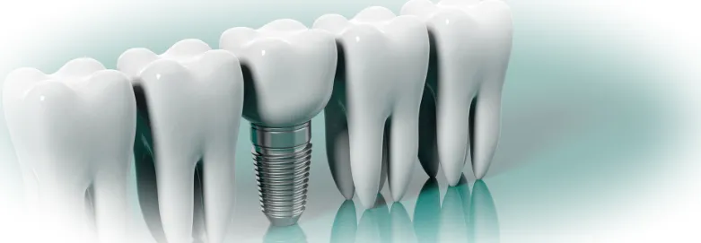 Импланты в стоматологии