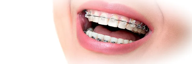 Методы достижения ровных зубов