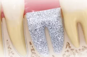 Синус-лифтинг перед имплантацией зубов